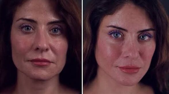 عمليات شد الوجه في الفن: حاجة مهنية أم مجرد موضة زائدة؟